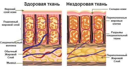 схема строения кожи с целлюлитом схема строения кожи с целлюлитом