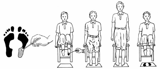 определение плоскостопия в домашних условиях