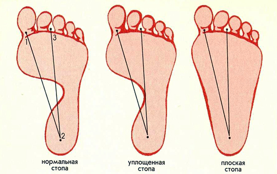 отпечатки стопы при разных степенях плоскостопия