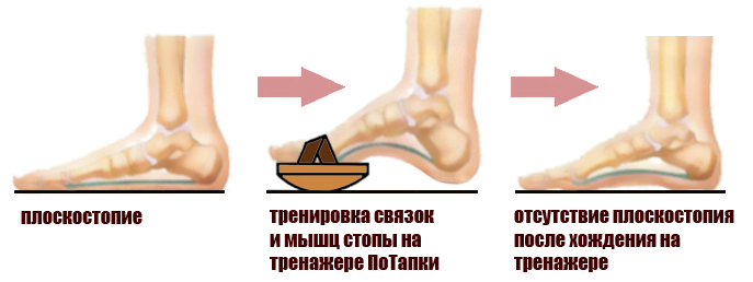 плоскостопие до и после тренировки в ПоТапках